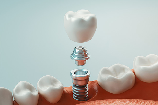 Implants Dentist Joliet